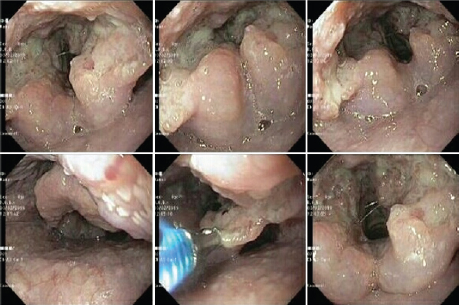 Upper gastrointestinal endoscopy showing fungating growth over oropharynx and whole oesophagus.